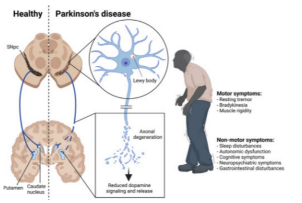 世界帕金森病日 | 帕金森病（PD）发病机制与基因编辑小鼠模型全解析